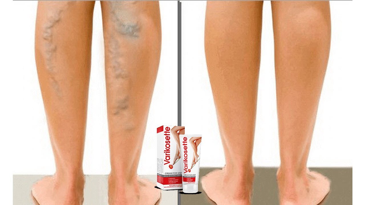 Varikosette Crema Para Que Sirve