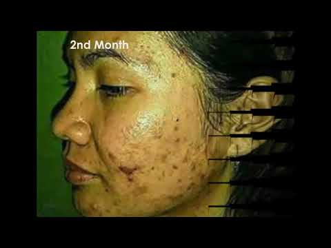 Dermalmd Best painful acne treatment Serum - from Dark To Glowing Skin