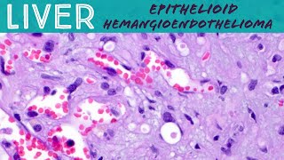 Rare Liver Tumor - Epithelioid hemangioendothelioma: Basic soft tissue pathology