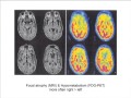 Non-Alzheimer's Disease Dementias