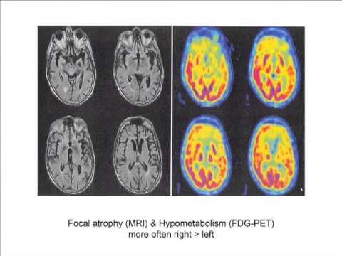 Non-Alzheimer's Disease Dementias Non-Alzheimer's Disease Dementias