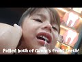 Pulled both of Gavin's front teeth!