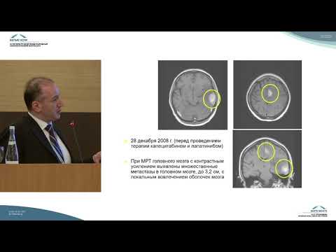 Видео: Клинический обзор: визуализация при ишемическом инсульте - последствия для неотложной помощи