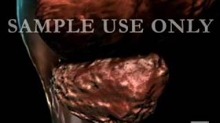 Condensed Transurethral Resection of the Prostate (TURP)
