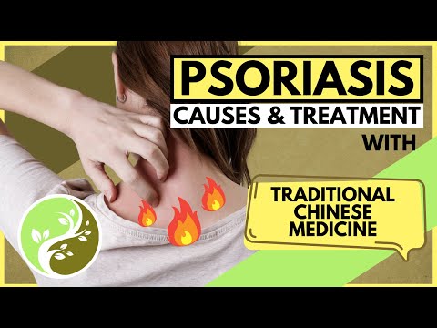 सोरायसिस के कारण और पारंपरिक चीनी चिकित्सा के साथ उपचार | सोरायसिस का इलाज स्वाभाविक रूप से करें