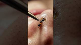 Rhythmic nose extraction (Pure Sound Only) 🧘♂️✨ #ASMR #porezen #oddlysatisfying #skincareasmr