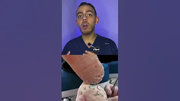 عين السمكة او السنطة في القدم اسبابها و طريقة علاجها والوقاية منها طب Shorts 