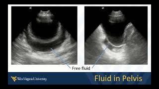 Abdominal POCUS 2 - Potential Spaces and Peritoneal Fluid