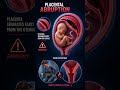 Placental Abruption #midwifery