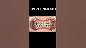 Hình ảnh trước và sau khi niềng răng móm