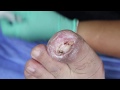 EP_1178 Infected big ingrown toenail removal 👣 จะเป็นลม..สงสารน้องมากก 😢 (This clip from Thailand)