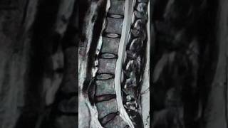 Lumbar disc bulges recovery at home #sciatica #backpain #sciaticapainrelief #fitfam #gym