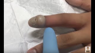 large infected bump on finger