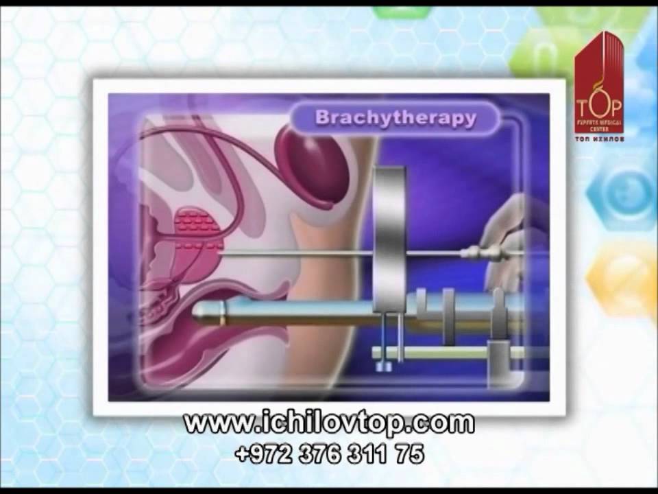 Аппарат для брахитерапии РМЖ. Брахитерапия излечивает. Брахитерапия рака отзывы