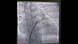 step by step ASD device closure at madras heart care centre.thanks dr sundar dr karthik Mr andrew