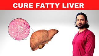 Ayurvedic diet for fatty liver | Cure for fatty liver disease [ Fatty liver disease explained ]