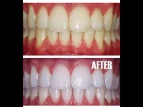KETAHUILAH Inilah Cara Memutihkan Gigi Dengan Garam 