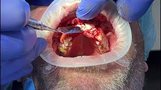 Application Of Sticky Bone Created Using Prf And Powerbone Granules