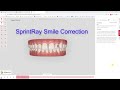 Sprintray clear aligner smile correction