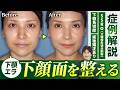 骨切りで下顎全体が小さく!30代女性の症例を解説【SSRO/エラ切除】