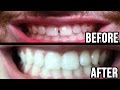 How To Close Small Gaps In Teeth Without Braces