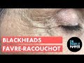 Blackheads Favre-Racouchot