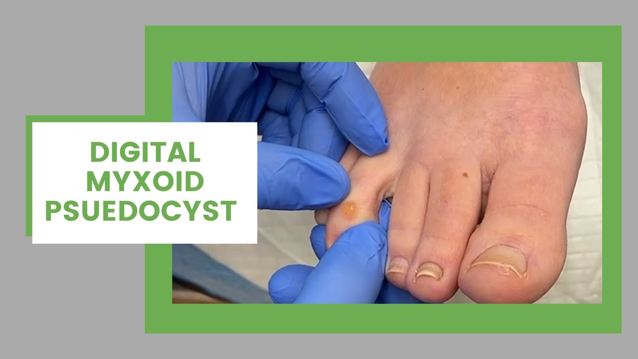 Brand new toe cyst