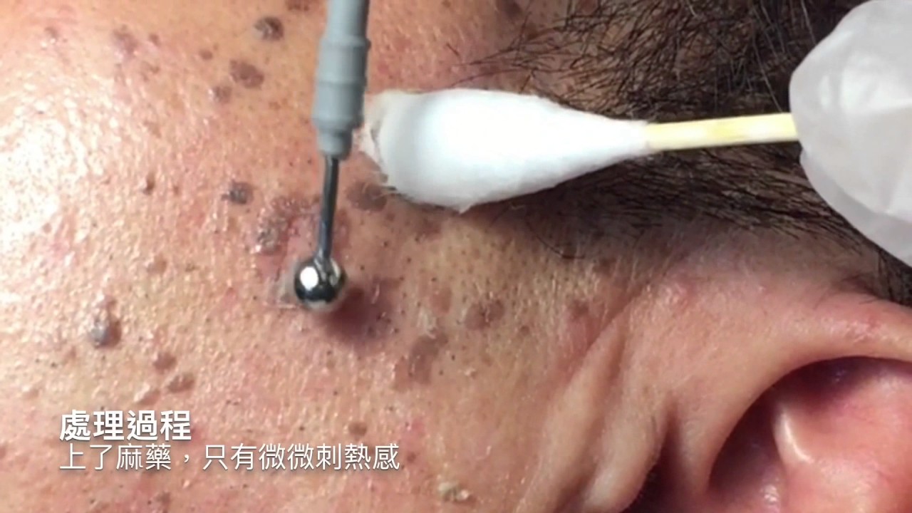 老人斑 頭皮大型脂漏性角化電燒 院長莊禮謙醫師美麗新城診所seborrheic Keratosis Warts 桃園中壢新竹苗栗台北基隆醫美除斑 Youtube