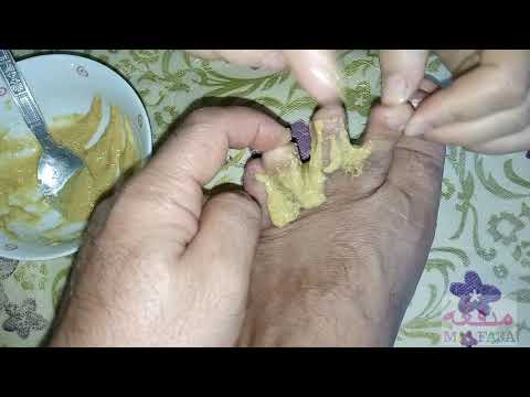 علاج الفطريات بين أصابع القدم و الاكزيما بوصفة مجربة و فعالة