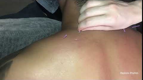 Local twitch response from dry needling a trigger point