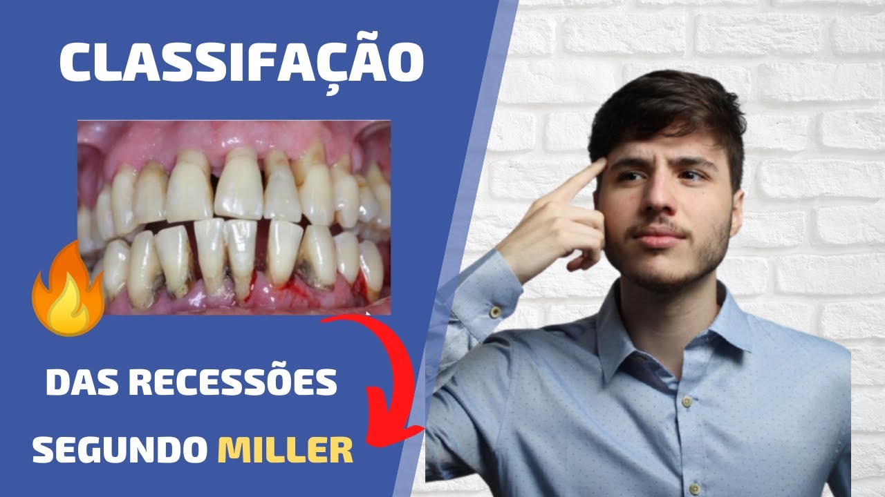 As 4 Classes de recessões gengivais segundo Miller | Periodontia DESCOMPLICADA