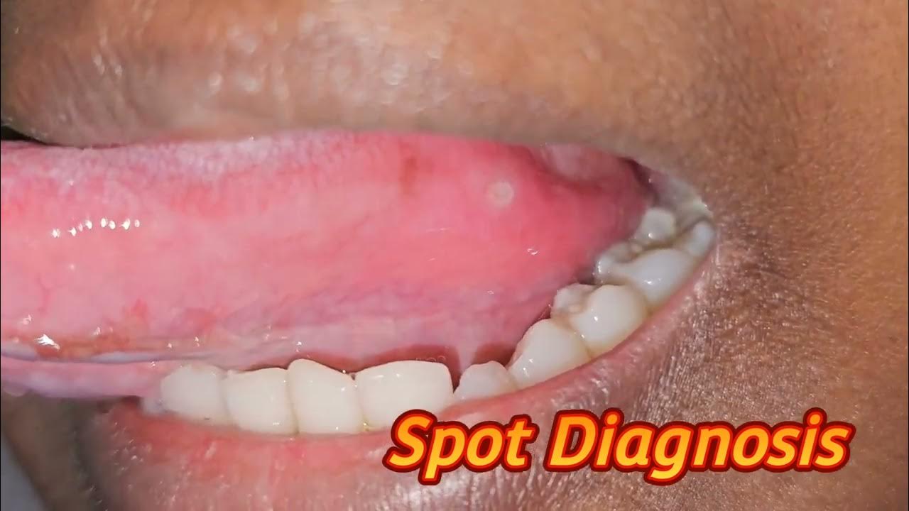 Spot Diagnosis Tongue Lesions Spotdiagnosis Tongue imwell Ulcers spot-diagnosis-tongue-lesions-spotdiagnosis-tongue-imwell-ulcers