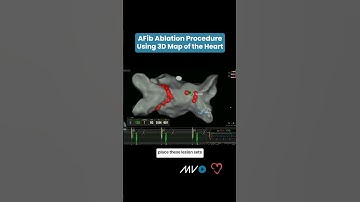 AFib Ablation Procedure Using 3D Map of Heart