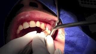 Dental Scaling - Root Planing - Teeth Polishing - تنظيف الجيوب اللثوية المحيطه بالاسنان