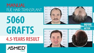 Manual FUE Saç Ekimi 5060 Greft 4.5 Yıllık Sonuç #hairtransplant #asmedhairtransplantresult #asmed