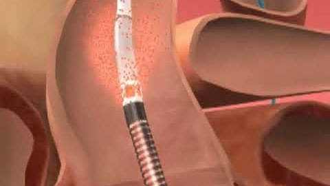 Impella Procedure