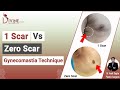 Scarless technique of gynecomastia surgery  1 scar vs zero scar  best plastic surgeon in india