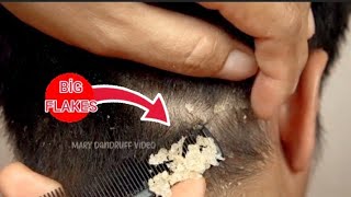 İnanılmaz Rahatlatan Kepek Temizleme Videosu | Dandruff (Egzama) Saç Bakım Hair Removal #kepek ASMR