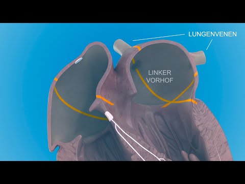 Video: Fakten Und Statistiken Zum Vorhofflimmern