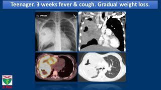 Primary Pulmonary Hodgkins Lymphoma