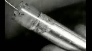 Oldest Root Canal Video - Filmed in 1917 by M. L. Rhein, MD, DDS