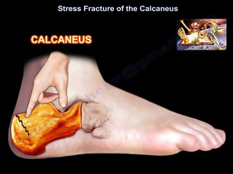 Calcaneal Tongue-Type Fracture Fixation (Open Reduction and Internal  Fixation) | Central Coast Orthopedic Medical Group