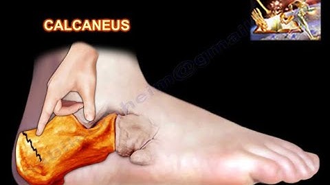 Stress Fracture of the Calcaneus - Everything You Need To Know - Dr. Nabil Ebraheim