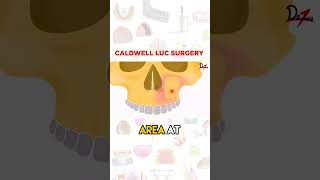 Caldwell Luc Surgery