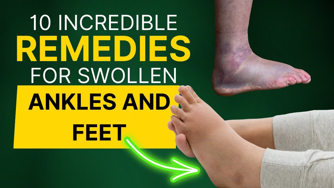 10 Incredible Remedies for Swollen Ankle and Feet YouTube