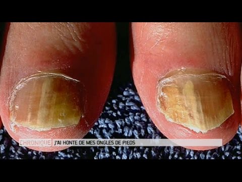 Vidéo: Troubles Des Pieds Et Des Ongles Chez Les Furets