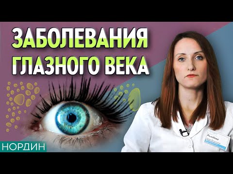 🟢 Воспаление век. Профилактика глазных заболеваний и уход за веками