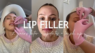 LIP FILLER VLOG: Healing process + my experience after 2 years!