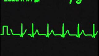 Accelerated Nodal Rhythm - ECG Simulator - Arrhythmia Simulator