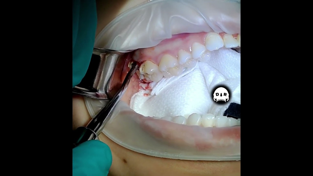 Curved Roots Tooth Extraction